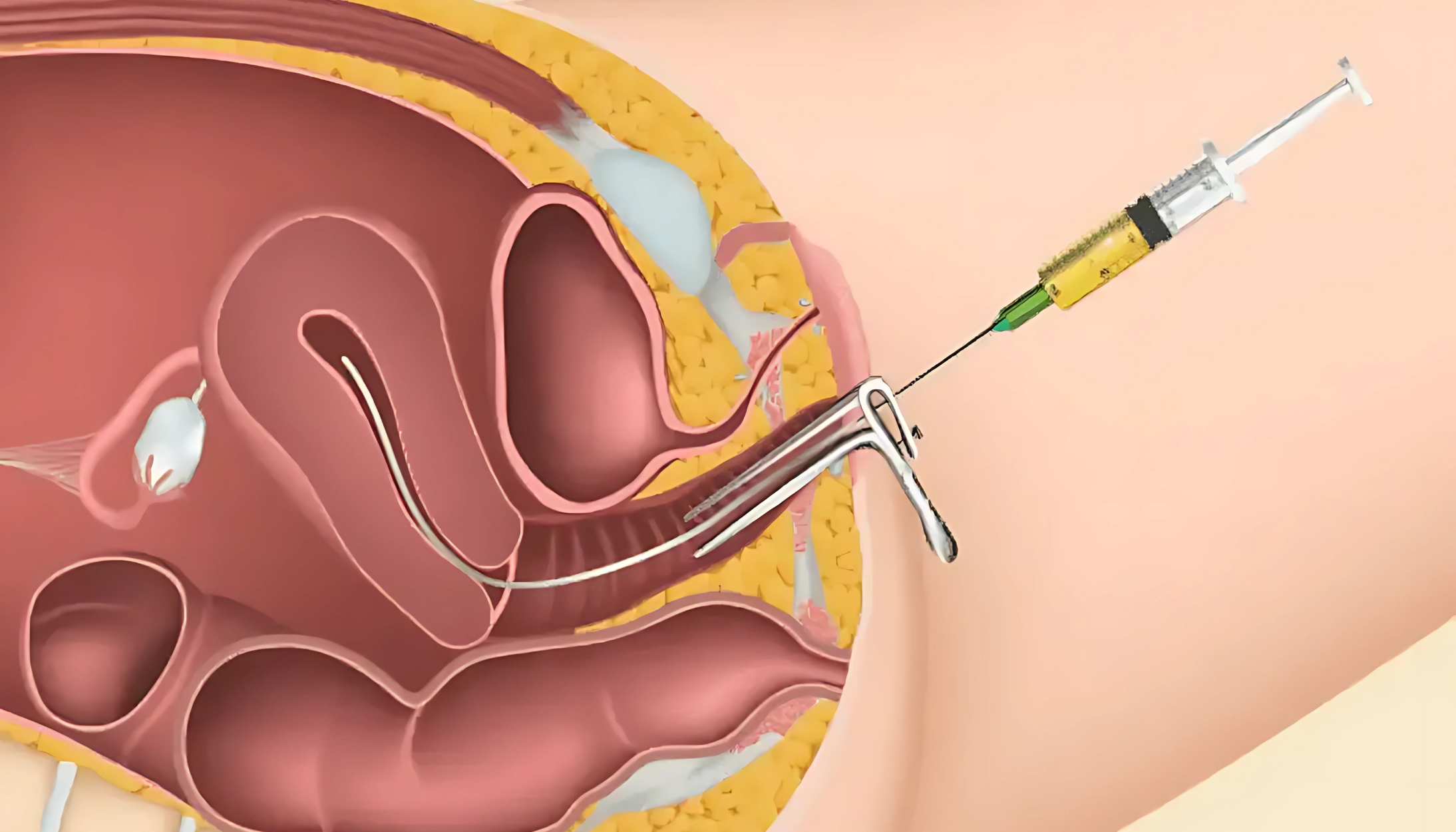 IUI – Intrauterine Insemination procedure at IV HOS
